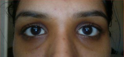 Làm thế nào để khắc phục tình trạng mắt trũng sâu?