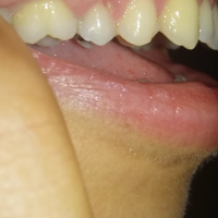 Mất một mảng lợi thì nên làm gì?