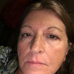 Cách giảm các nếp nhăn sâu ở vùng dưới của mặt hiệu quả nhất?