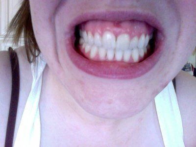Có nên phẫu thuật hạ môi trên để trị cười hở lợi không?