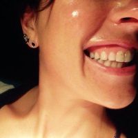 Cách xử lý răng cửa quá to và cười hở lợi