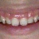 Răng cửa bị xoay và cười hở lợi thì có phù hợp với phương pháp phẫu thuật cắt lợi không?