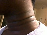 Cách loại bỏ các rãnh sâu trên cổ?