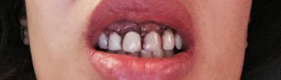 Răng bị thay đổi kích thước sau khi phẫu thuật cắt lợi