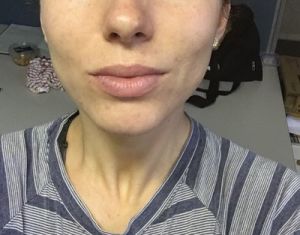 Laser tái tạo bề mặt da có trị được sẹo mụn và tăng sắc tố không?