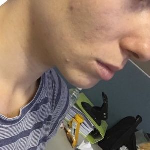 Laser tái tạo bề mặt da có trị được sẹo mụn và tăng sắc tố không?