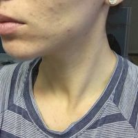 Laser tái tạo bề mặt da có trị được sẹo mụn và tăng sắc tố không? Laser tái tạo bề mặt da có trị được sẹo mụn và tăng sắc tố không?