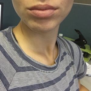 Laser tái tạo bề mặt da có trị được sẹo mụn và tăng sắc tố không?