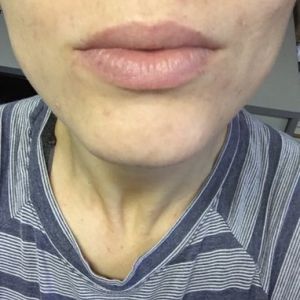 Laser tái tạo bề mặt da có trị được sẹo mụn và tăng sắc tố không?