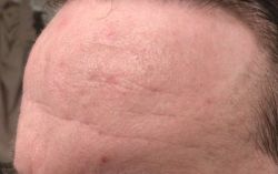 Sẹo mụn và nếp nhăn trên trán có phù hợp với laser tái tạo bề mặt?