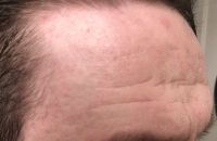 Sẹo mụn và nếp nhăn trên trán có phù hợp với laser tái tạo bề mặt? Sẹo mụn và nếp nhăn trên trán có phù hợp với laser tái tạo bề mặt?