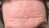 Sẹo mụn và nếp nhăn trên trán có phù hợp với laser tái tạo bề mặt? Sẹo mụn và nếp nhăn trên trán có phù hợp với laser tái tạo bề mặt?