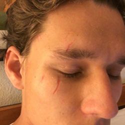 Tái tạo bề mặt da bằng laser có trị được sẹo do vết thương để lại không?