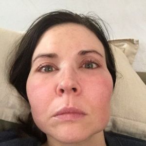 Bị sưng sau khi trị liệu bằng IPL có bình thường không?