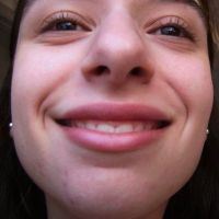 Phẫu thuật tạo hình môi có làm cho lợi bị hở nhiều hơn không?