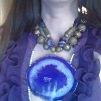 Đã tiêm Sculptra và Radiesse nhưng da vẫn bị chảy xệ quanh hàm