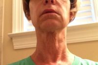 Cần làm gì để khắc phục tình trạng chảy xệ quanh cằm và cổ gà tây?