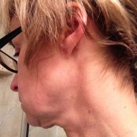 Cần làm gì để khắc phục tình trạng chảy xệ quanh cằm và cổ gà tây?