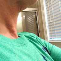 Cần làm gì để khắc phục tình trạng chảy xệ quanh cằm và cổ gà tây?