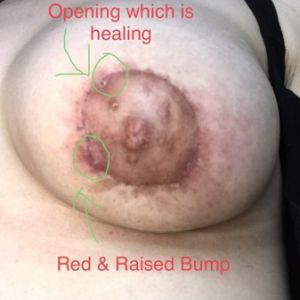 Đây có phải là tình trạng viêm mô tế bào? (ảnh)