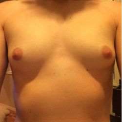 Liệu tôi có sai lầm khi chọn túi độn có độ nhô rất cao?