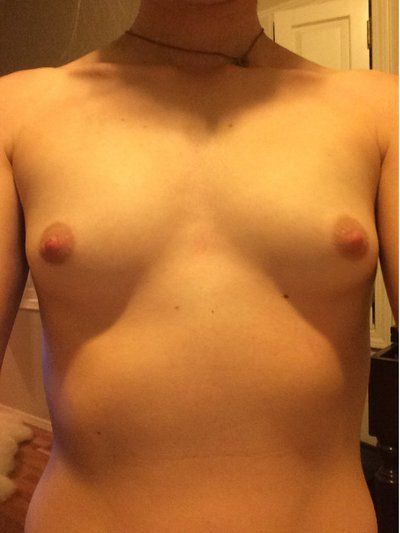 Liệu tôi có sai lầm khi chọn túi độn có độ nhô rất cao? Liệu tôi có sai lầm khi chọn túi độn có độ nhô rất cao?