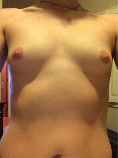 Liệu tôi có sai lầm khi chọn túi độn có độ nhô rất cao? Liệu tôi có sai lầm khi chọn túi độn có độ nhô rất cao?