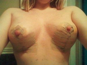 Có phải dáng ngực hình nón là hoàn toàn bình thường sau khi mới phẫu thuật?