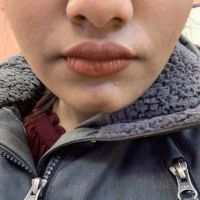 Cung hàm bị hẹp lại sau khi niềng răng thì cần làm gì?