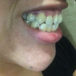 Khắc phục vấn đề khớp cắn và răng khấp khểnh mà không cần phẫu thuật