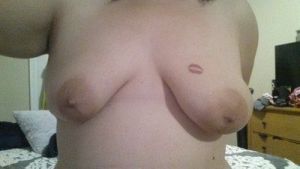 Hai bên ngực lệch nhau quá nhiều, phải làm gì?