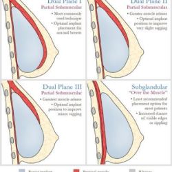 Vị trí đặt túi độn Dual plane có gì khác biệt (ảnh)