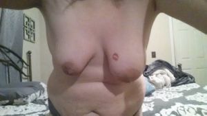 Hai bên ngực lệch nhau quá nhiều, phải làm gì?