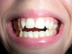 Răng bị thưa ra trong quá trình niềng có bình thường không?