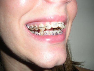 Răng bị thưa ra trong quá trình niềng có bình thường không?