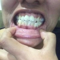 Khắc phục vấn đề khớp cắn và răng khấp khểnh mà không cần phẫu thuật