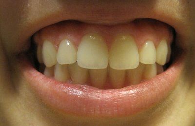 Mài kẽ răng có khắc phục được khớp cắn sâu không?