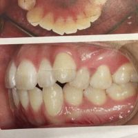 Cần nhổ mấy răng để có thể niềng răng