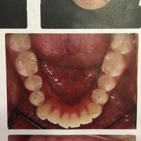 Cần nhổ mấy răng để có thể niềng răng