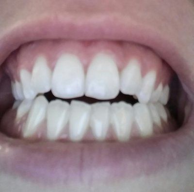 Răng cửa ở hai hàm không chạm nhau thì cần làm gì?