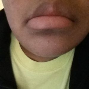 Hai hàm không thẳng hàng thì nên niềng răng hay phẫu thuật hàm?