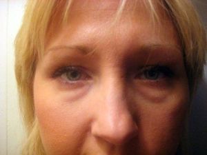 Nên cắt mí hay tiêm filler để trị bọng mắt do di truyền?