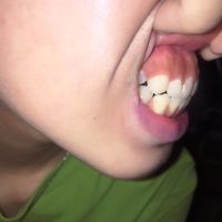 Hô do hàm hay do răng?