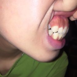 Hô do hàm hay do răng?