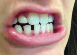 Có thể niềng răng sau khi đã trồng răng Implant không?