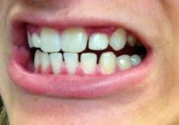 Có thể niềng răng sau khi đã trồng răng Implant không?