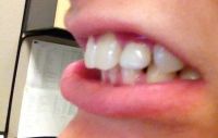 Có thể niềng răng sau khi đã trồng răng Implant không?