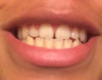 Khắc phục khe hở giữa răng cửa mà không cần niềng răng?