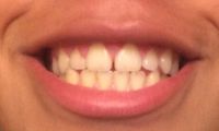 Khắc phục khe hở giữa răng cửa mà không cần niềng răng?
