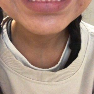 Nên chọn niềng kim loại, niềng trong suốt hay phẫu thuật để sửa khớp cắn sâu?